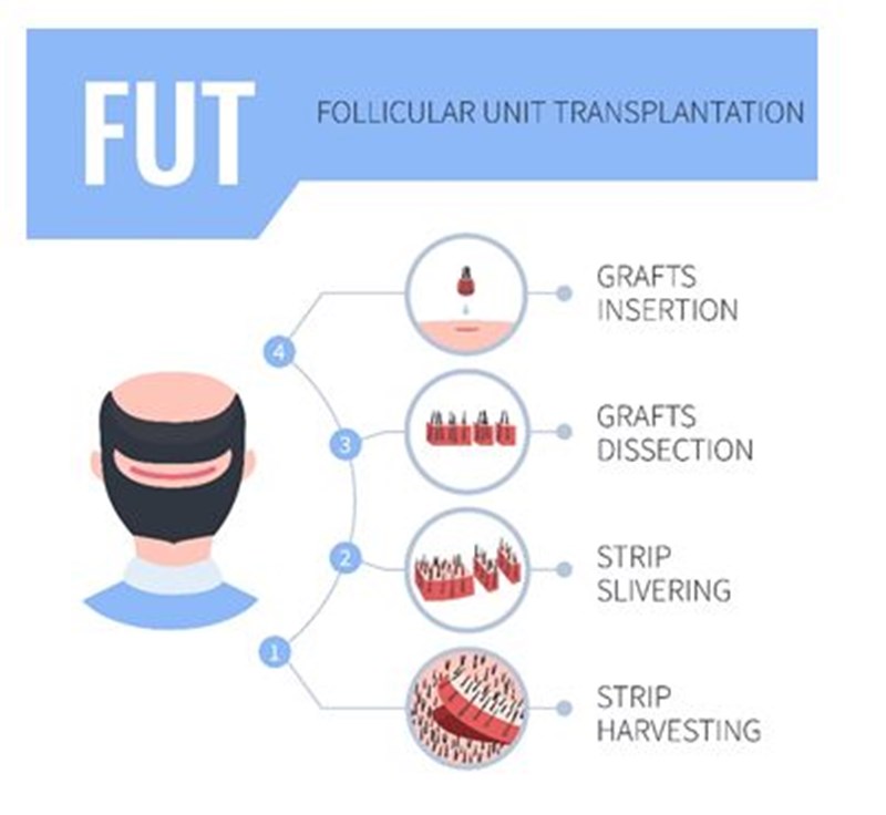 ΜΕΤΑΜΟΣΧΕΥΣΗ ΜΑΛΛΙΩΝ