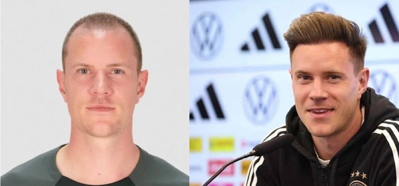 Η μεταμόσχευση μαλλιών του Τερ Στέγκεν