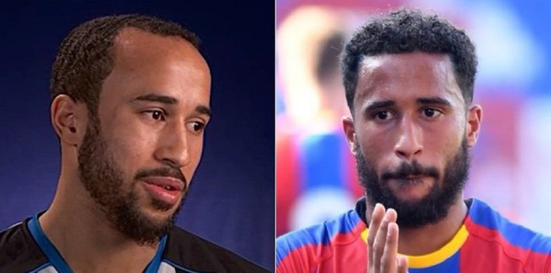 Η μεταμόσχευση μαλλιών του Άντρος Τάουνσεντ