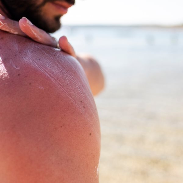 Πώς να ανακουφιστείς από το κάψιμο του ήλιου πιο γρήγορα από ποτέ