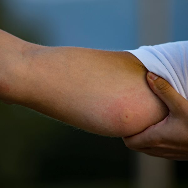 Οδηγός επιβίωσης από τσίμπημα εντόμου, τσούχτρας ή δάγκωμα φιδιού