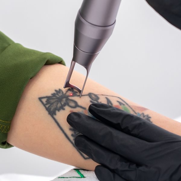 Όλα όσα πρέπει να γνωρίζεις προτού αφαιρέσεις ένα τατουάζ