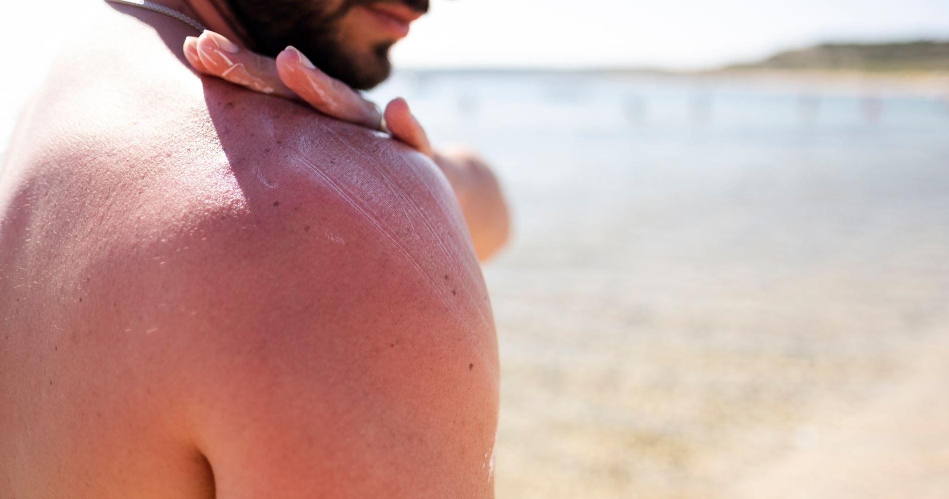 Πώς να ανακουφιστείς από το κάψιμο του ήλιου πιο γρήγορα από ποτέ