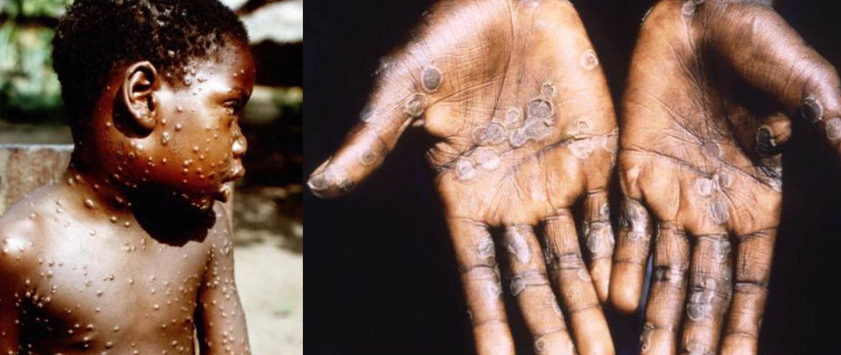 Όλα όσα γνωρίζουμε μέχρι στιγμής για την ευλογιά των πιθήκων