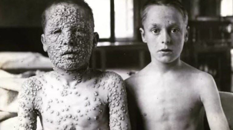 Πώς τα εμβόλια εξόντωσαν την ευλογιά και όχι μόνο