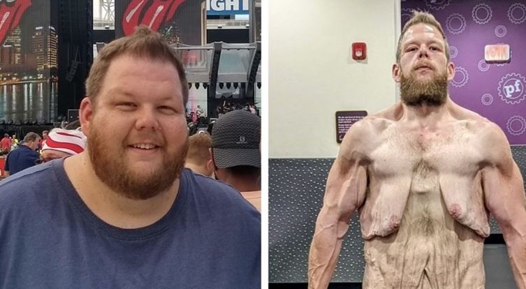 Ένας άντρας έχασε 152 κιλά και ιδού τα αποτελέσματα