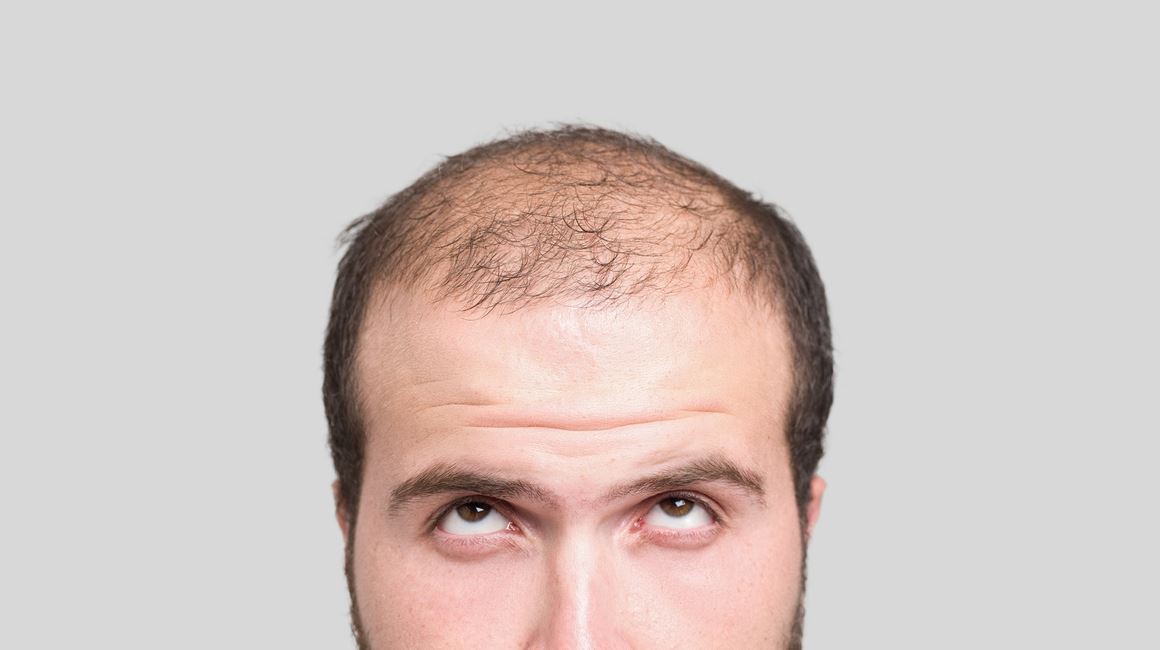 Η θεραπεία για να αντιμετωπίσεις αποτελεσματικά την αραίωση και την τριχόπτωση